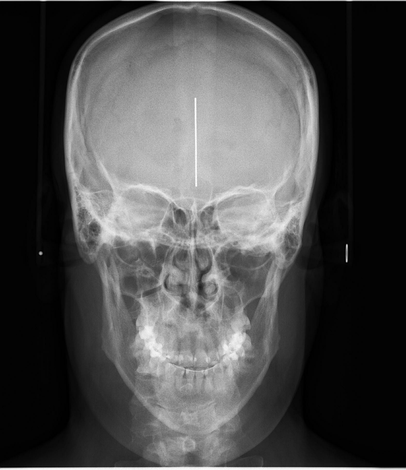 Telerradiografia Frontal